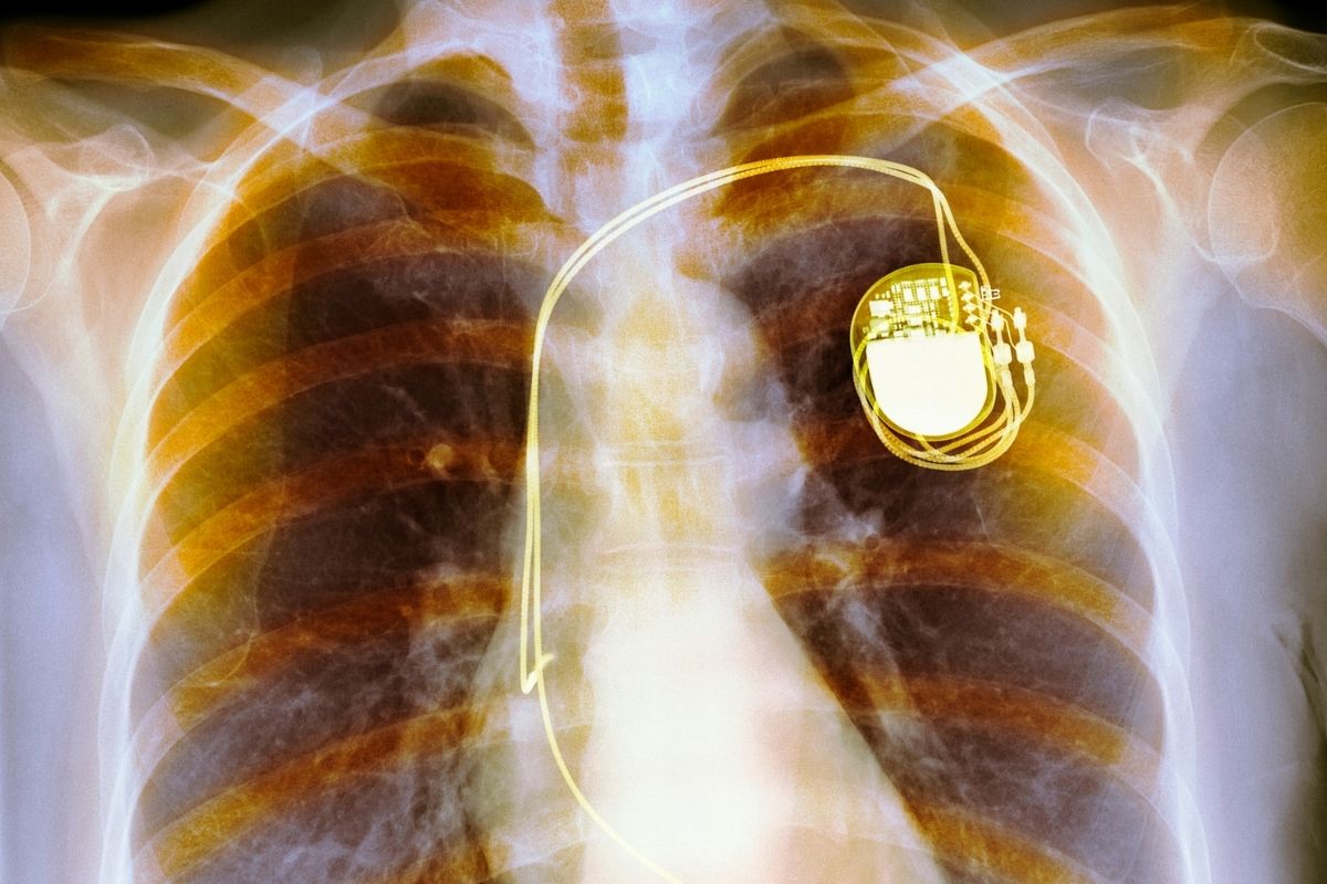 Smartphone magnetic fields - pacemaker X-RAY