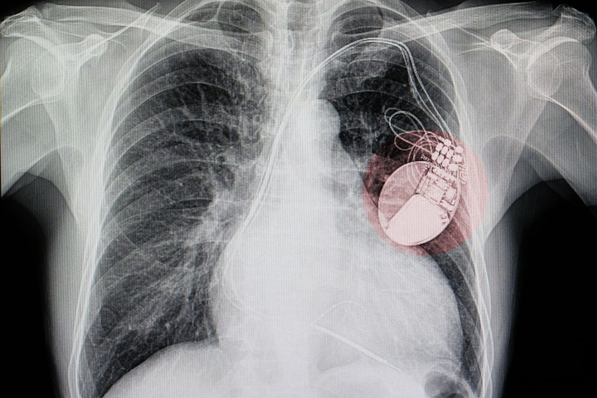Wearable technology - X-Ray - Pacemaker