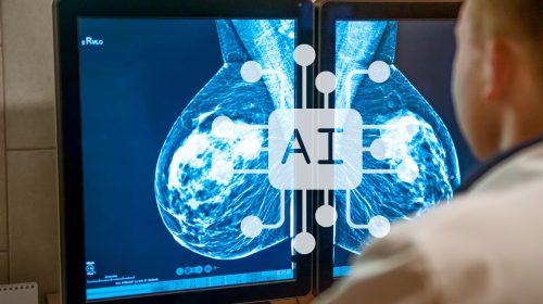 Artificial intelligence - breast cancer results