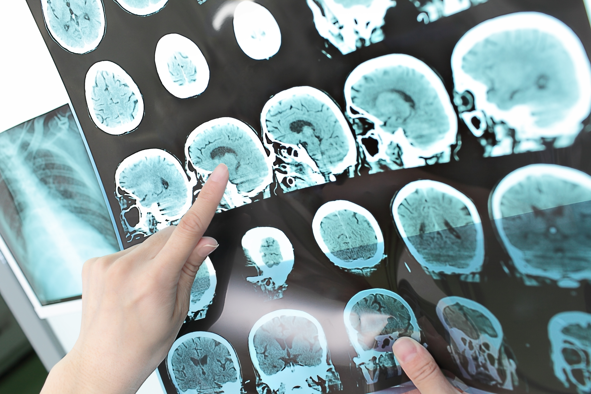 An artificial intelligence brain implant is allowing a stroke victim to speak again 2 Artificial intelligence - brain research - medical
